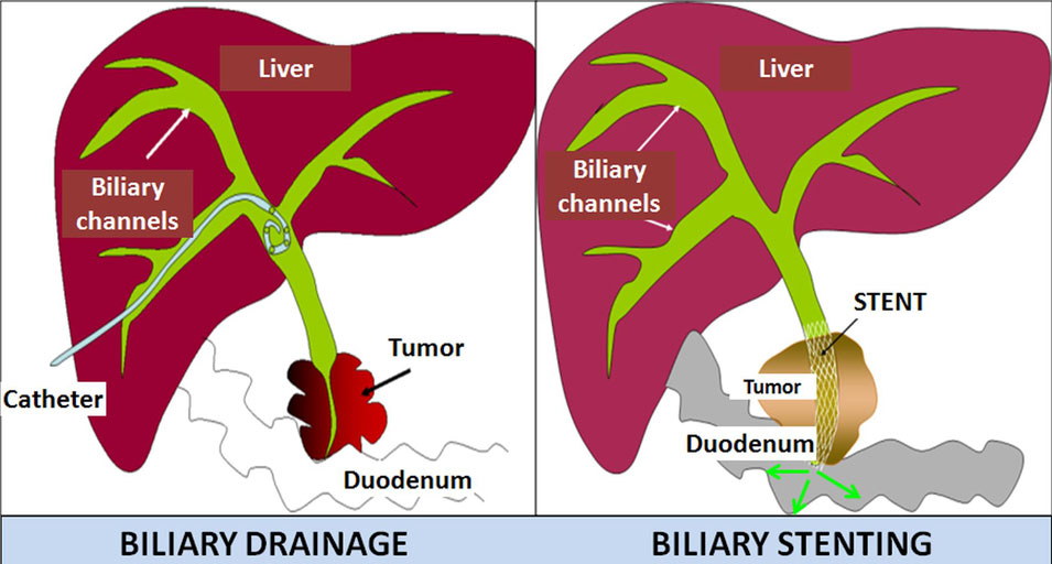 Treatment of bile obstruction